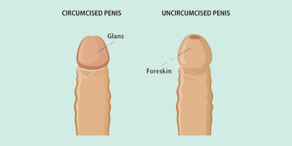 circumcised and uncircumcised penis