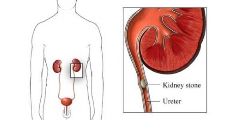 kidney stone in the ureter