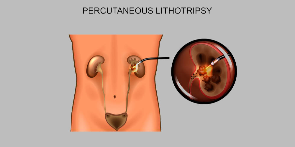 lithotripsy treatment for kidney stones