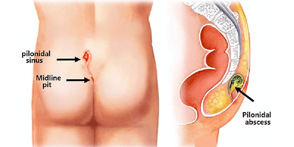 pilonidal cyst near tailbone