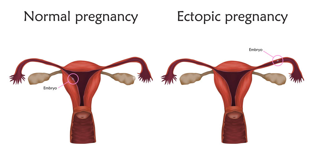 ectopic pregnancy