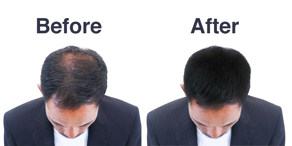 Hair Transplantation Results Before & After
