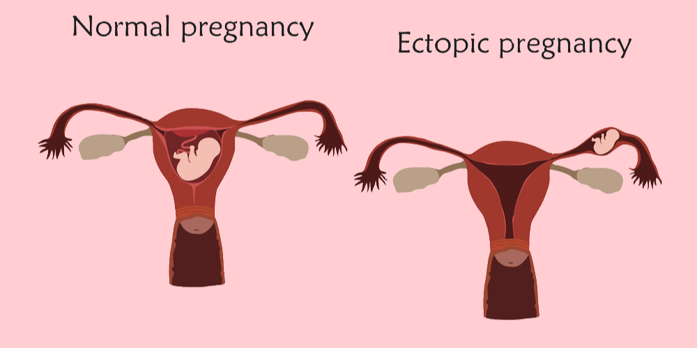 1. Ectopic Pregnancy Awareness Tattoo - wide 8