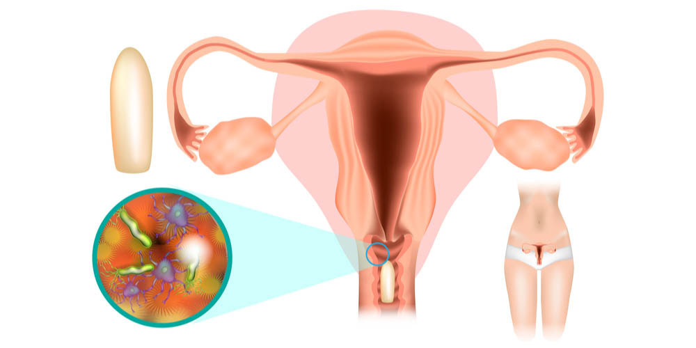 diagram showing vaginal suppository or vaginal capsule in the vagina