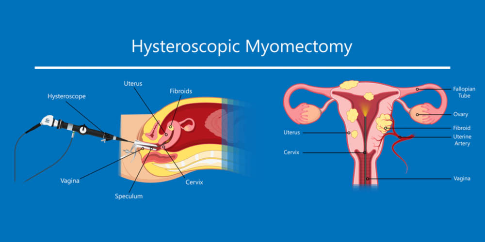 Hysteroscopic Myomectomy