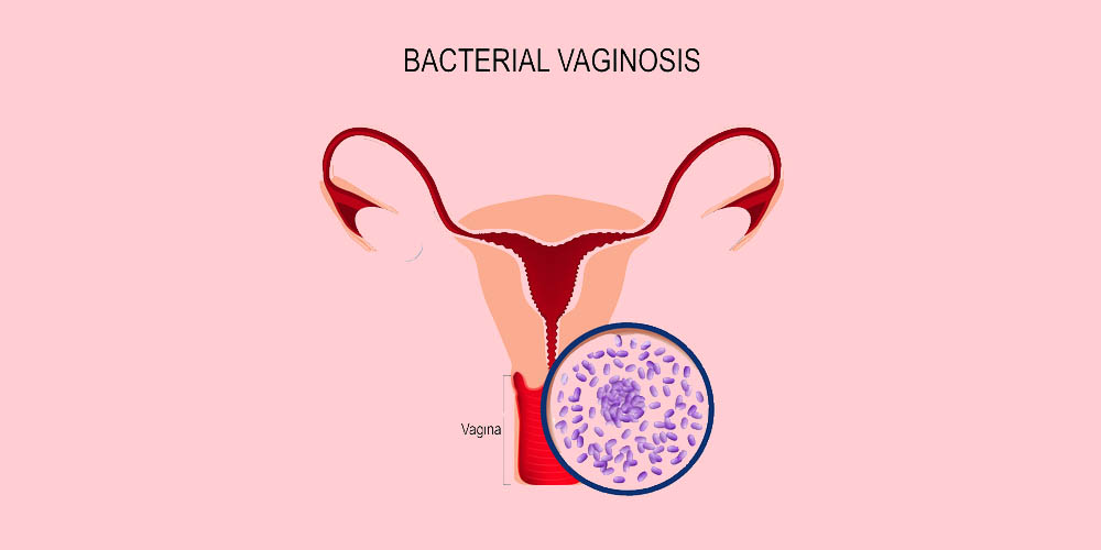 bacterial vaginosis