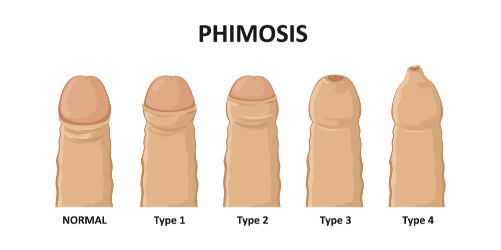 phimosis tight foreskin