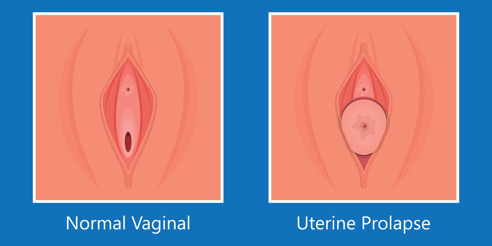 prolapsed. uterus