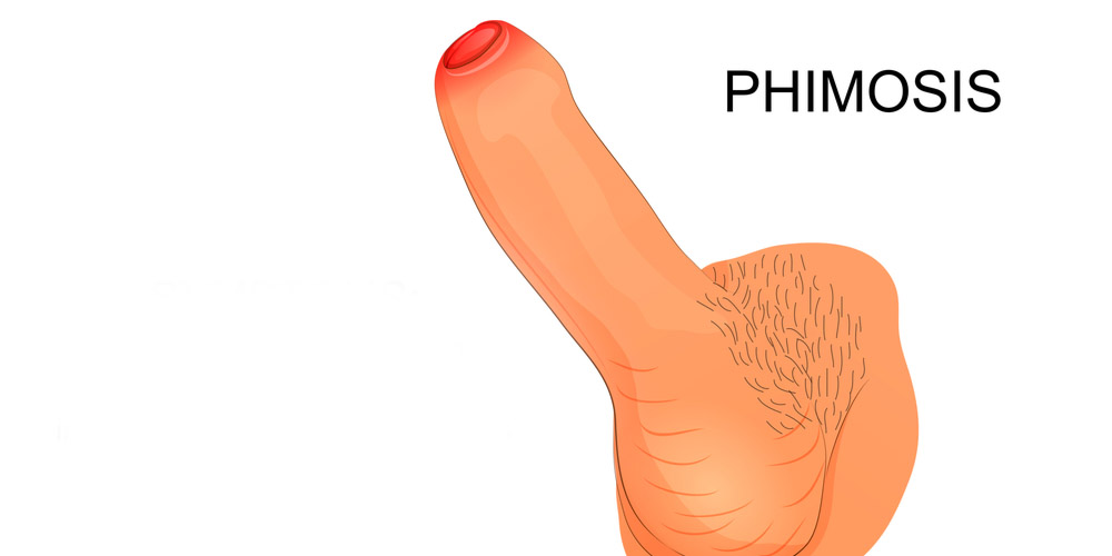 phimosis-tight foreskin