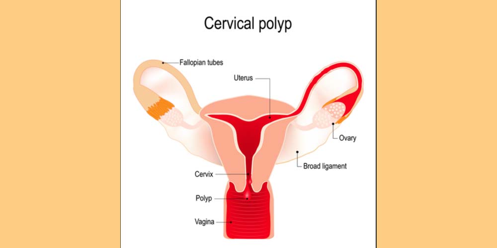cervical polyp 