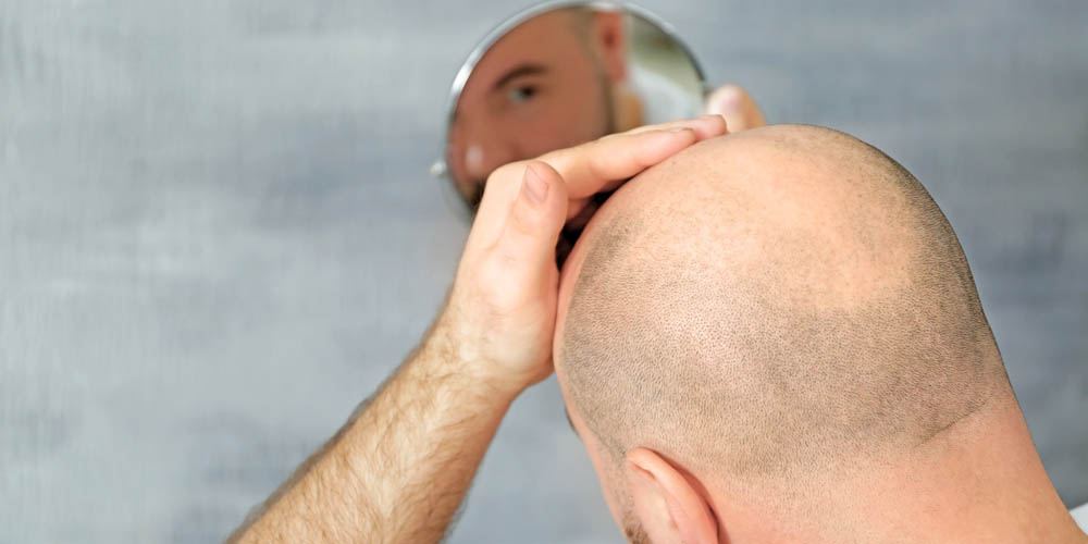 Man with bald head