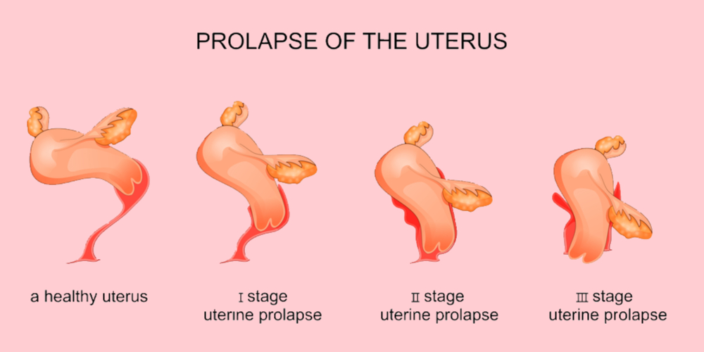prolapsed. uterus