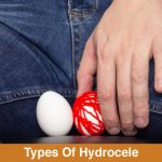 types of hydrocele