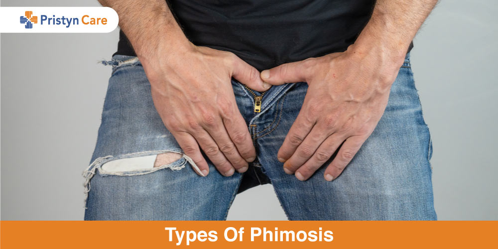 types of phimosis