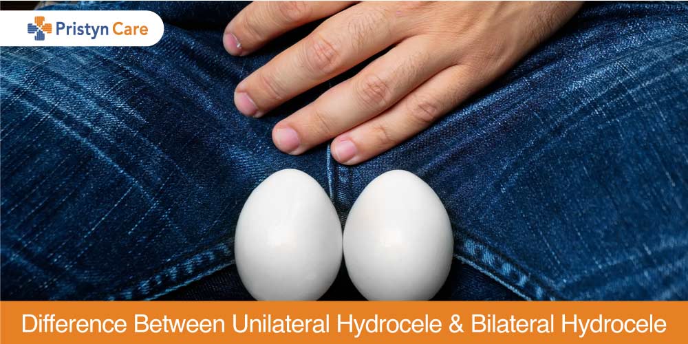 unilateral and bilateral hydrocele