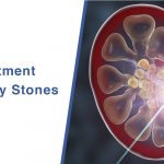 Best-Treatment-For-Kidney-Stones