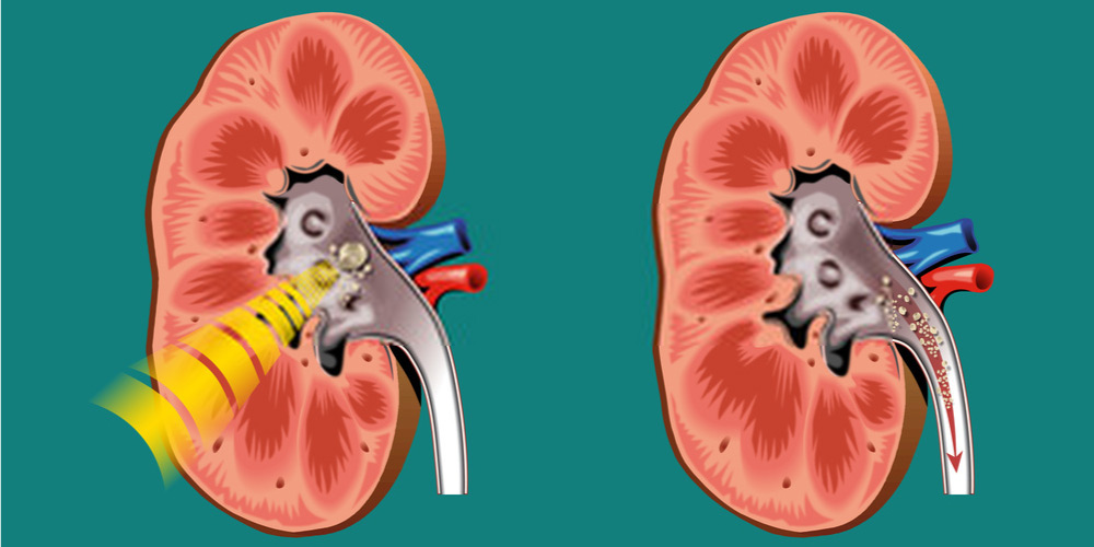 shock wave lithotripsy for kidney stones