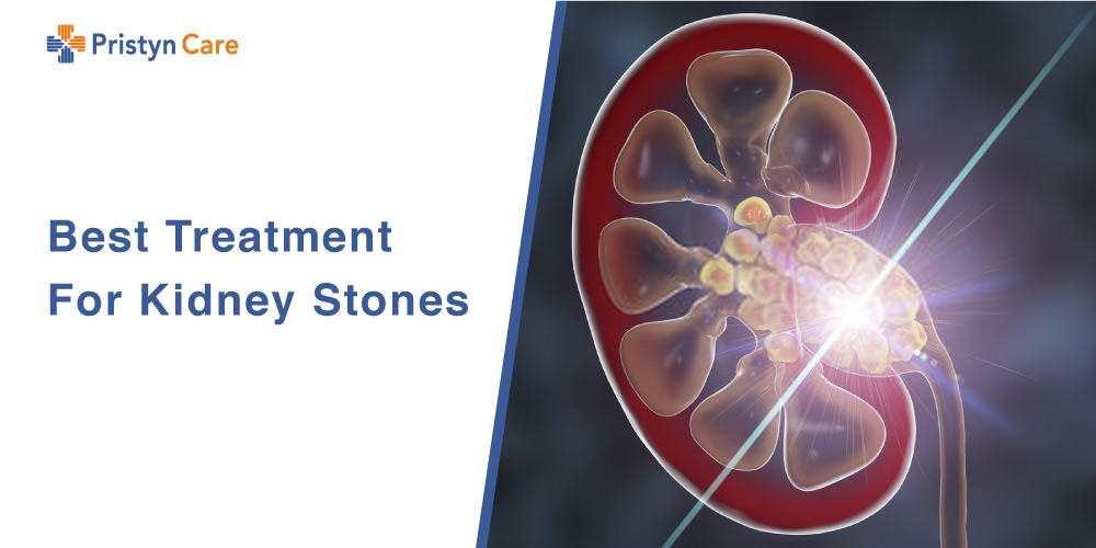 Best-Treatment-For-Kidney-Stones
