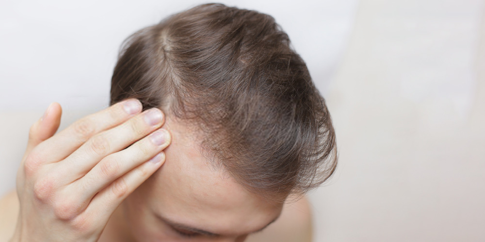 Man facing hair fall