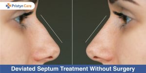 Deviated-Septum-Treatment-Without-Surgery