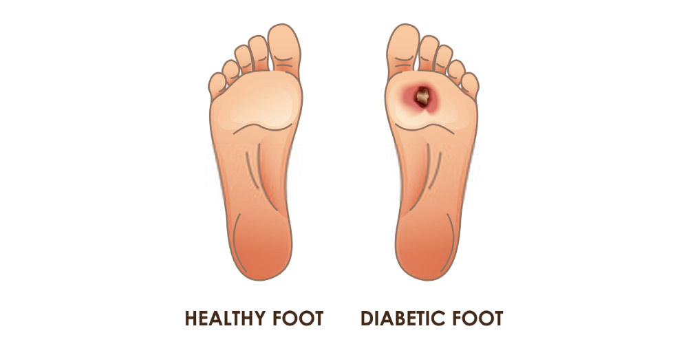 healthy vs diabetic foot