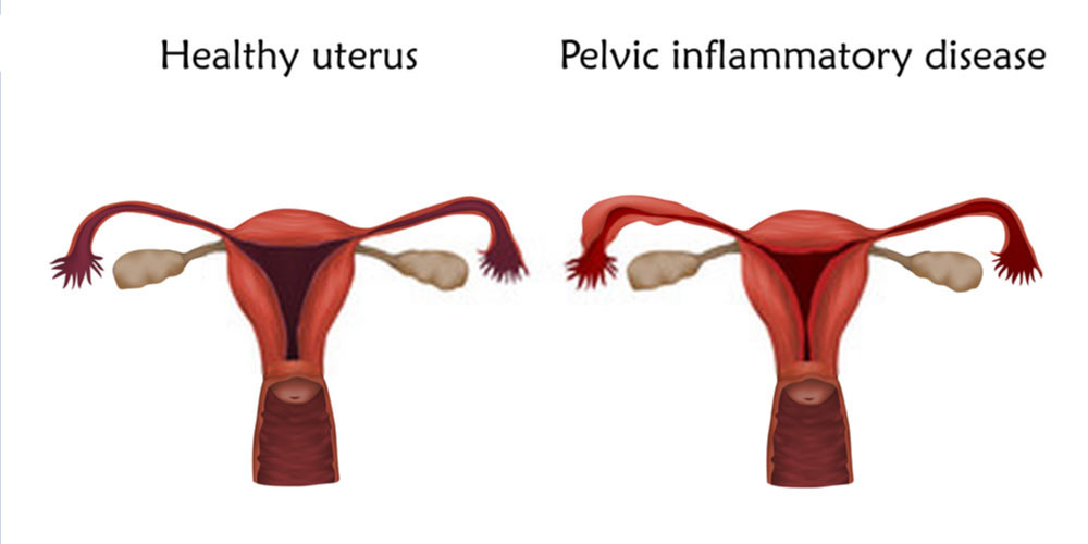 Pelvic Inflammatory Disease