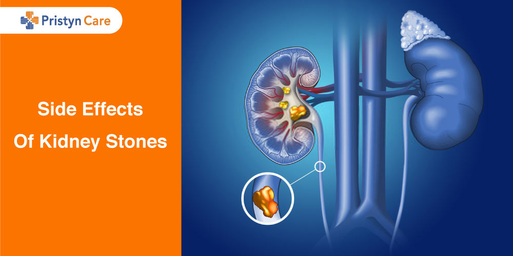 Side-Effects-Of-Kidney-Stones