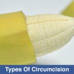 Types-Of-Circumcision
