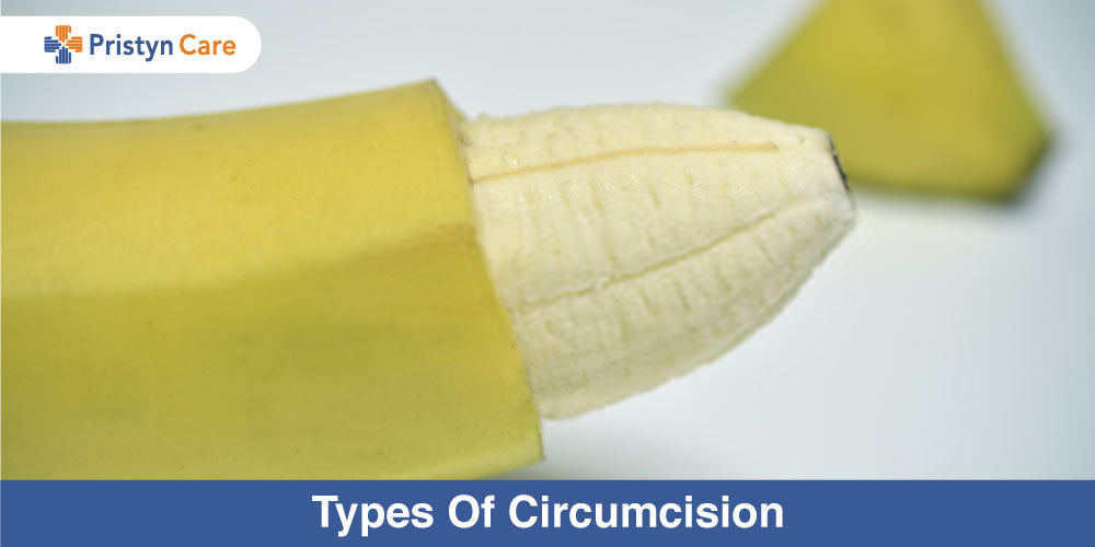 Types-Of-Circumcision