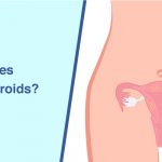 What-Causes-Uterine-Fibroids