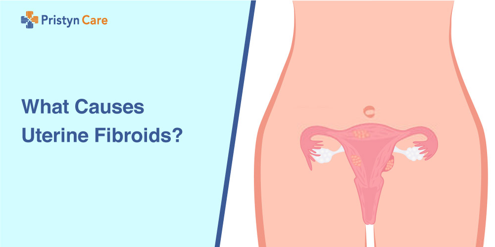 What-Causes-Uterine-Fibroids