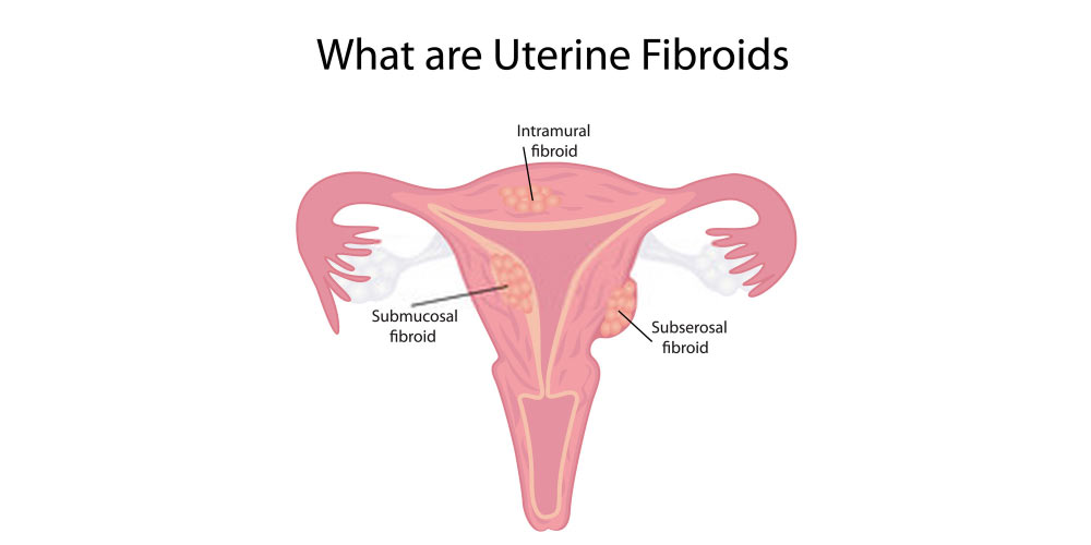 different types of uterine fibroids