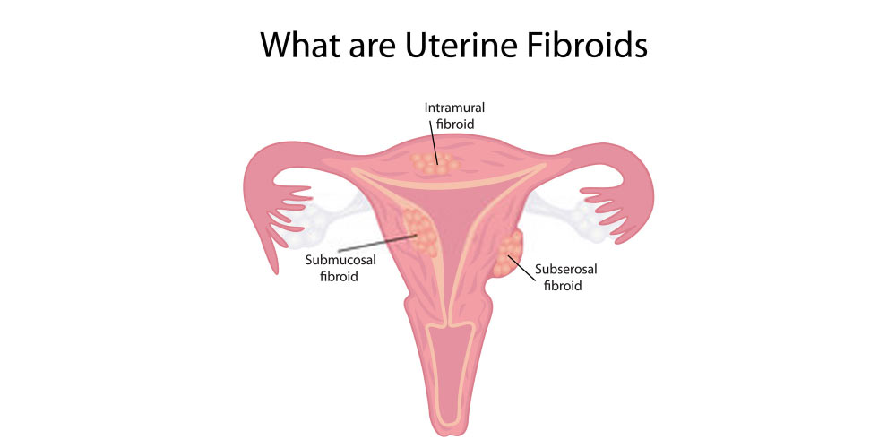 different types of uterine fibroids