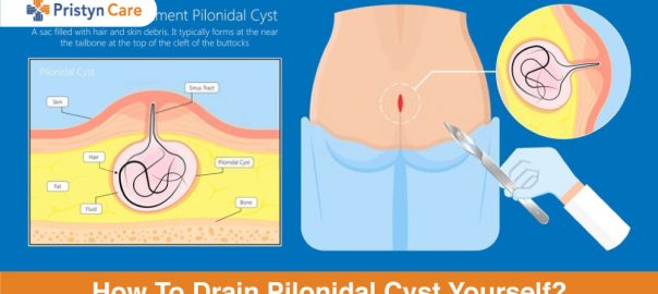 How To Drain Pilonidal Cyst Yourself?