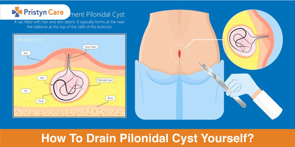how to drain pilonidal cyst yourself