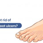 how to get rid of diabetic foot ulcers