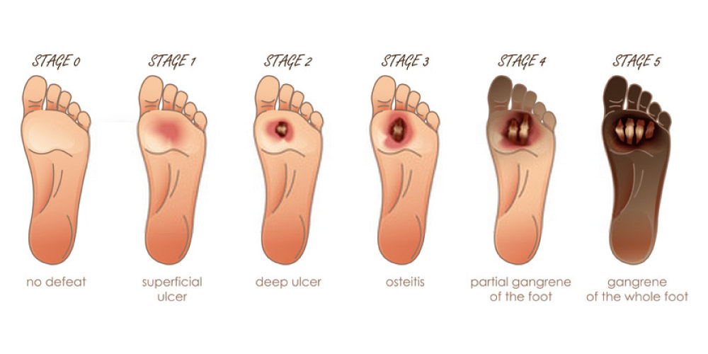 stages of diabetic foot ulcer