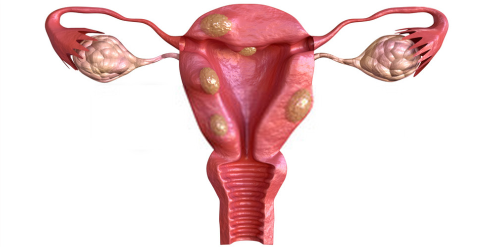 uterus with fibroids