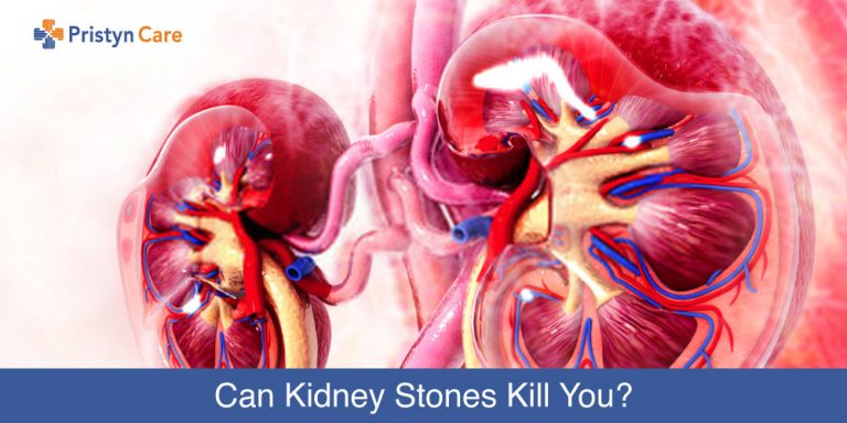 Can-Kidney-Stones-Kill-You