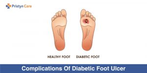 Complications-Of-Diabetic-Foot-Ulcer