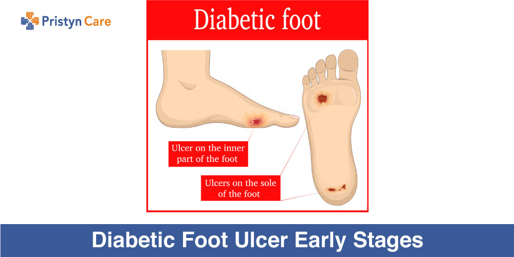 Diabetic-Foot-Ulcer-Early-Stages