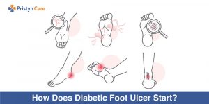 How-Does-Diabetic-Foot-Ulcer-Start