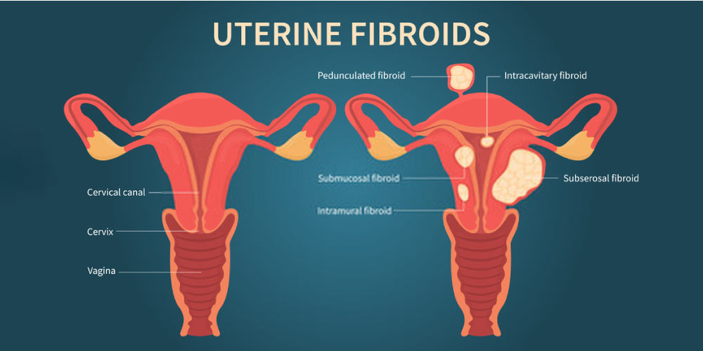 Uterine Fibroids-location of fibroids in the uterus