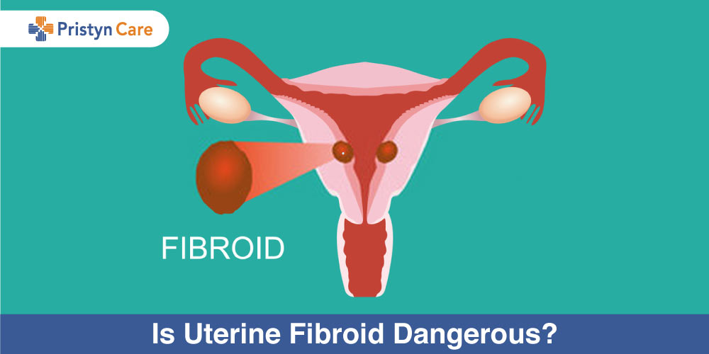 Is-Uterine-Fibroid-Dangerous