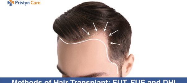 Methods of Hair Transplant: FUT, FUE and DHI