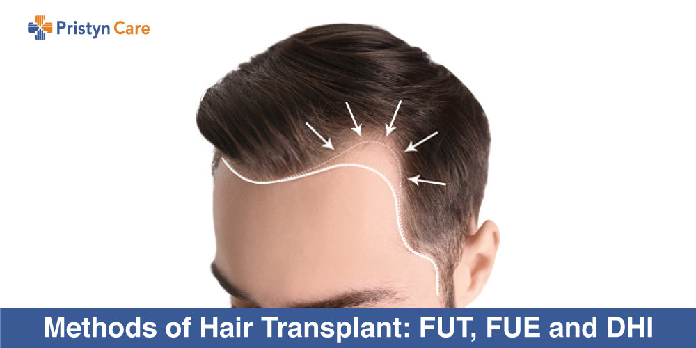 Methods of Hair Transplant: FUT, FUE and DHI