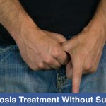 Phimosis Treatment Without Surgery