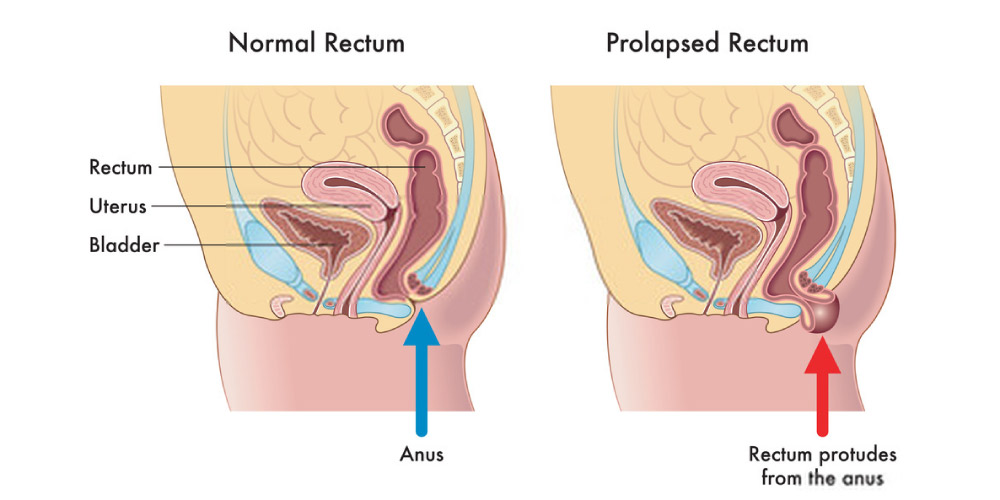 Rectal Prolapse