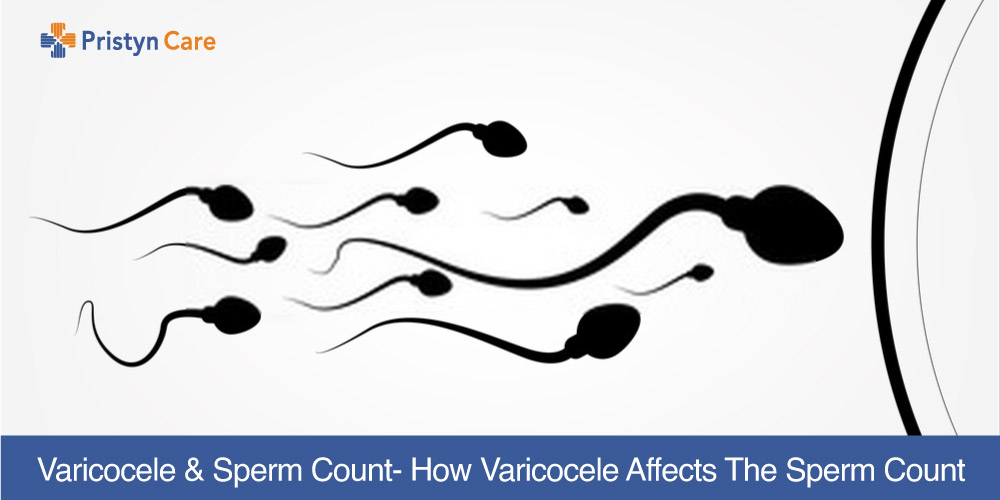 Varicocele and sperm count