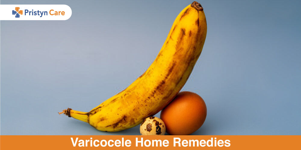 Varicose Veins Treatment: Home Remedies, Natural, One day Cure